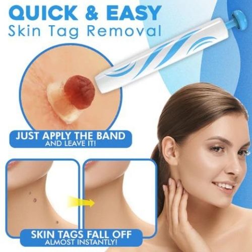 Skin Tag Remover